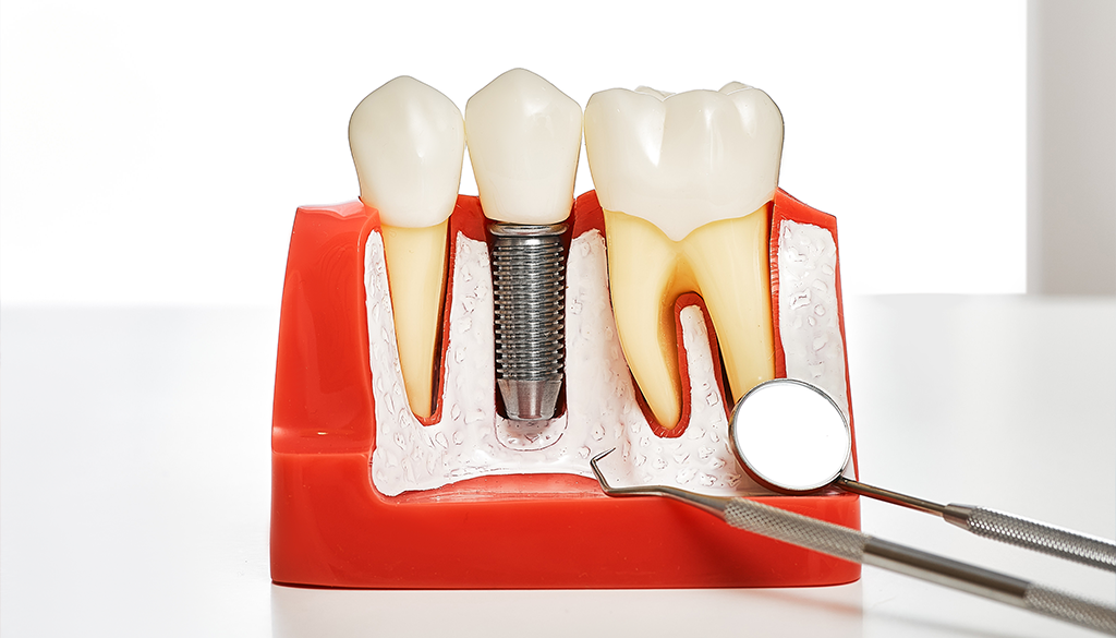 Dental implants Oakville