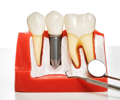 Dental implants Oakville
